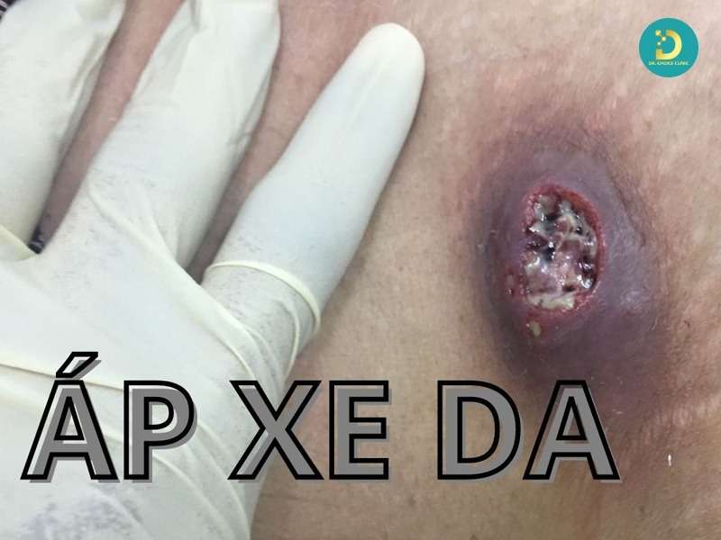 Phòng Khám Trị Nhọt, Áp Xe Hiệu Quả An Toàn Tại TP.HCM 15 Mức độ nguy hiểm và biến chứng có thể gặp