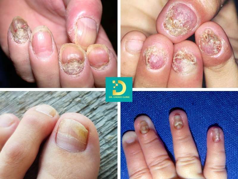Phòng Khám Chữa Nấm Móng Uy Tín Hiệu Quả HCM 8 Nấm móng là gì? nguyên nhân hình thành do đâu?