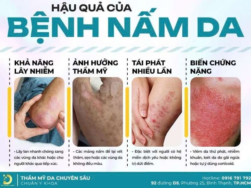 Phòng Khám Điều Trị Nấm Thân Mình Uy Tín, Hiệu Quả HCM 9 Nấm thân mình là gì? cách nhận biết chính xác
