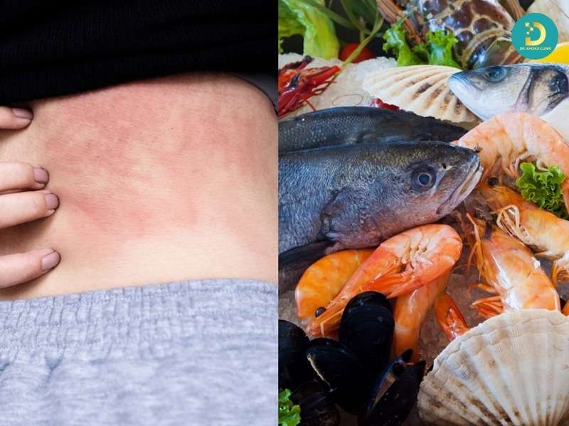 Phòng Khám Trị Mề Đay Hiệu Quả, An Toàn Tại TP.HCM 13 Nguyên nhân gây mề đay thường gặp