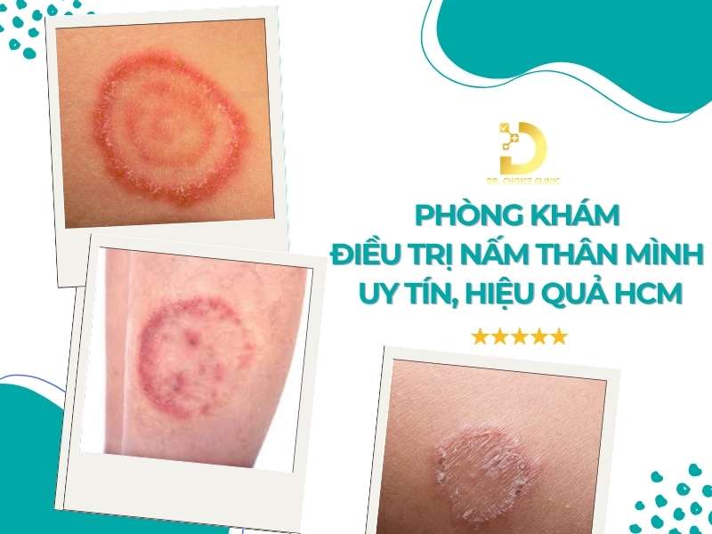 Phòng Khám Điều Trị Nấm Thân Mình Uy Tín, Hiệu Quả HCM 8 Phòng khám điều trị nấm thân mình uy tín