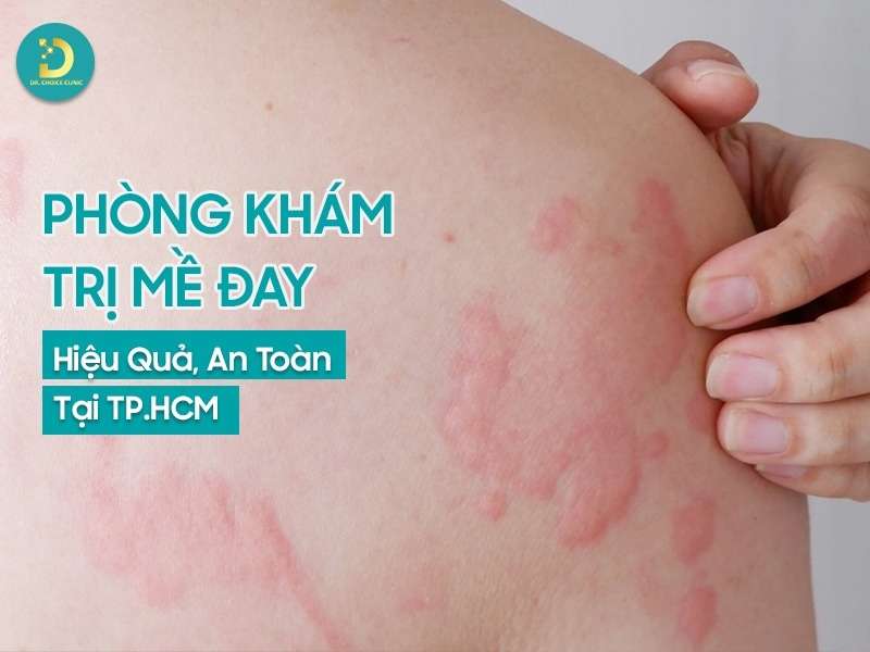 Phòng Khám Trị Mề Đay Hiệu Quả, An Toàn Tại TP.HCM 11 Phòng khám trị mề đay hiệu quả