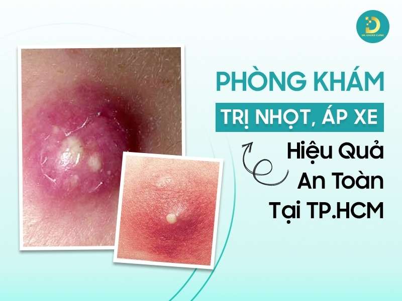 Phòng Khám Trị Nhọt, Áp Xe Hiệu Quả An Toàn Tại TP.HCM 13 Phòng khám trị nhọt, áp xe hiệu quả
