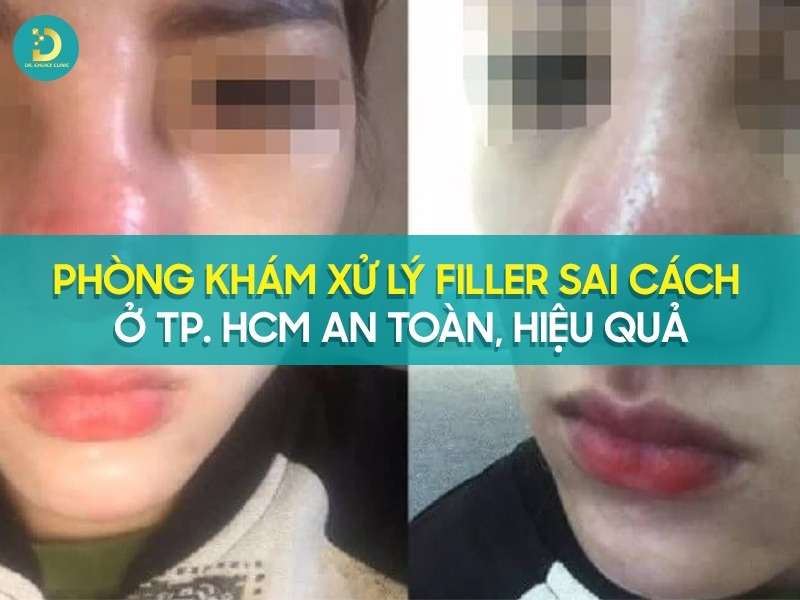 Phòng Khám Xử Lý Filler Sai Cách Ở TP. HCM An Toàn, Hiệu Quả 9 Phòng khám xử lý filler sai cách ở tp. HCM