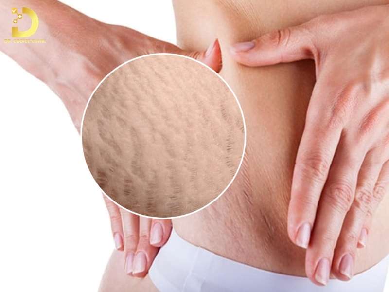 Phòng Khám Điều Trị Sẹo Rạn Da An Toàn, Hiệu Quả Tại TP.HCM 9 Tổng quan về sẹo rạn da