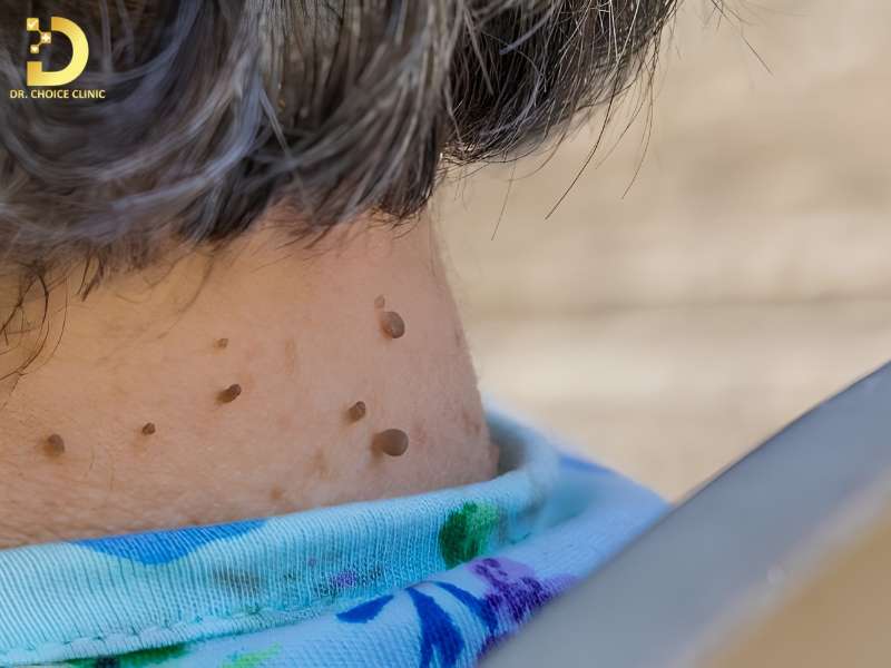 Phòng Khám Điều Trị Skin Tag (U Mềm Treo) An Toàn, Hiệu Quả Tại TP.HCM 9 Dấu hiệu nhận biết và cách phân biệt