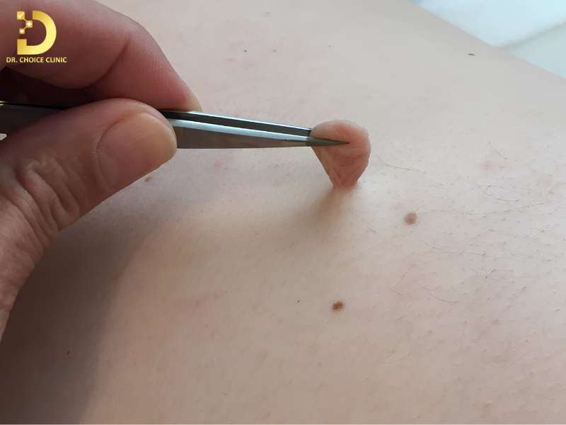 Phòng Khám Điều Trị Skin Tag (U Mềm Treo) An Toàn, Hiệu Quả Tại TP.HCM 10 Vì sao skin tag không nên tự ý loại bỏ tại nhà?