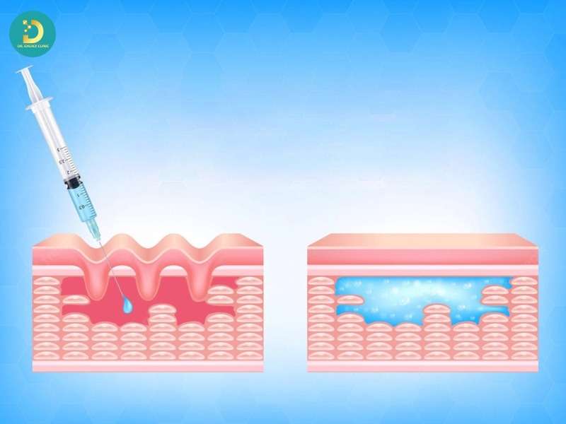 Phòng Khám Xử Lý Filler Sai Cách Ở TP. HCM An Toàn, Hiệu Quả 14 Xác định loại filler & vị trí (có thể dùng siêu âm)