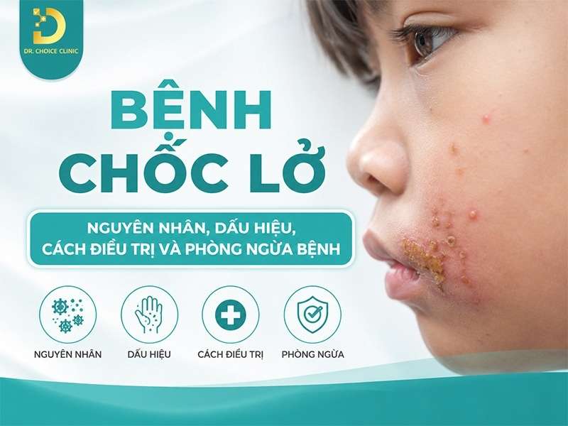 Bệnh Chốc Lở: Nguyên Nhân, Dấu Hiệu, Cách Điều Trị Và Phòng Ngừa Bệnh 11 Bệnh chốc lở