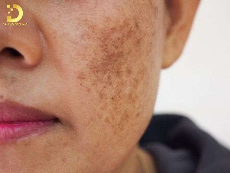 Top Bệnh Về Da Mùa Hè Thường Gặp & Cách Phòng Ngừa Hiệu Quả 34 Bệnh da do ánh sáng
