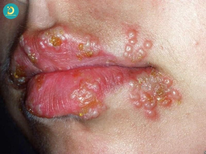 Các Bệnh Ngoài Da Do Virus Thường Gặp & Cách Điều Trị Hiệu Quả 15 Bệnh Herpes môi