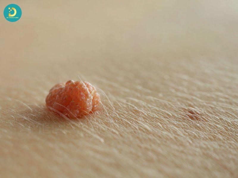 Các Bệnh Ngoài Da Do Virus Thường Gặp & Cách Điều Trị Hiệu Quả 18 Mụn cóc là bệnh ngoài da do virus HPV gây ra