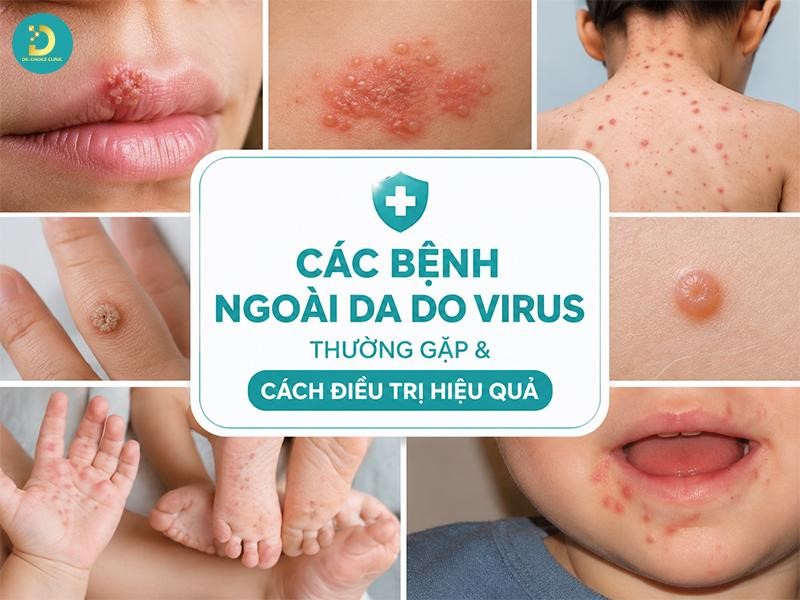 Các Bệnh Ngoài Da Do Virus Thường Gặp & Cách Điều Trị Hiệu Quả 14 Tìm hiểu các bệnh ngoài da do virus