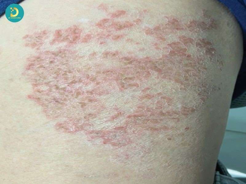 Các Bệnh Nhiễm Trùng Da Thường Gặp: Nguyên Nhân, Dấu Hiệu Và Cách Điều Trị 16 Bệnh nhiễm trùng da do ký sinh trùng