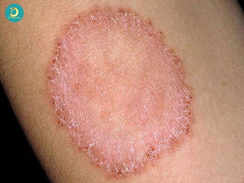 Các Bệnh Nhiễm Trùng Da Thường Gặp: Nguyên Nhân, Dấu Hiệu Và Cách Điều Trị 14 Bệnh nhiễm trùng da do nấm