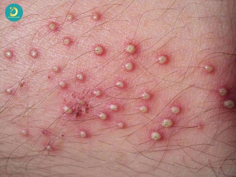 Các Bệnh Nhiễm Trùng Da Thường Gặp: Nguyên Nhân, Dấu Hiệu Và Cách Điều Trị 13 Bệnh nhiễm trùng da do vi khuẩn