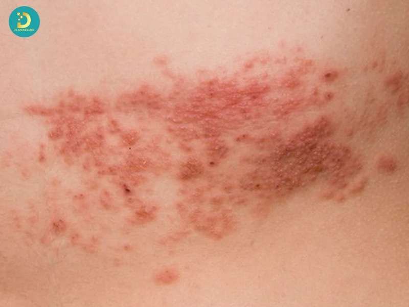 Các Bệnh Nhiễm Trùng Da Thường Gặp: Nguyên Nhân, Dấu Hiệu Và Cách Điều Trị 15 Bệnh nhiễm trùng da do virus