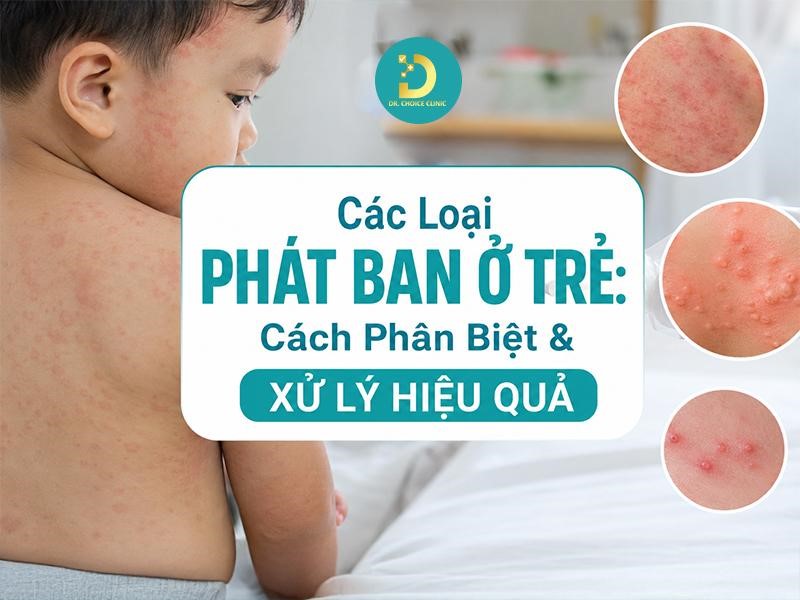 Các Loại Phát Ban Ở Trẻ: Cách Phân Biệt & Xử Lý Hiệu Quả 13 Tìm hiểu các loại bệnh phát ban ở trẻ em