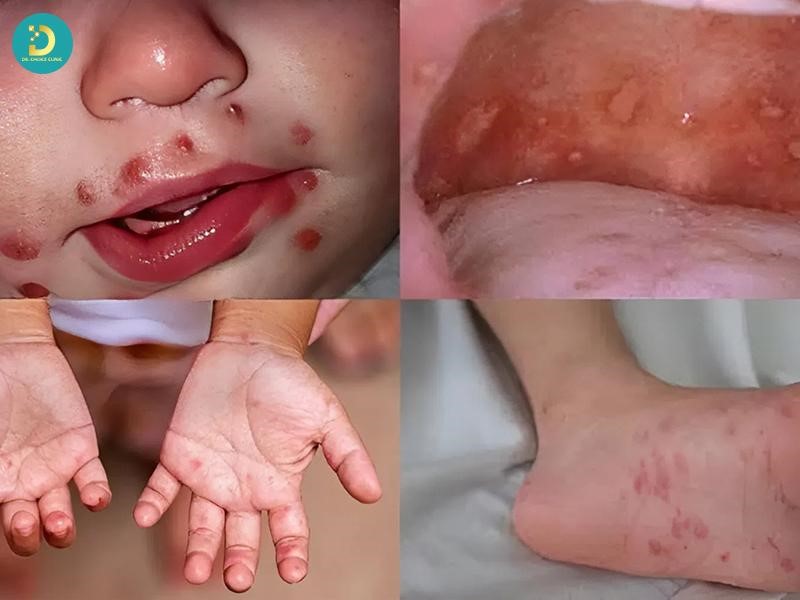 Các Bệnh Ngoài Da Do Virus Thường Gặp & Cách Điều Trị Hiệu Quả 20 Tay chân miệng là bệnh do Enterovirus gây ra,