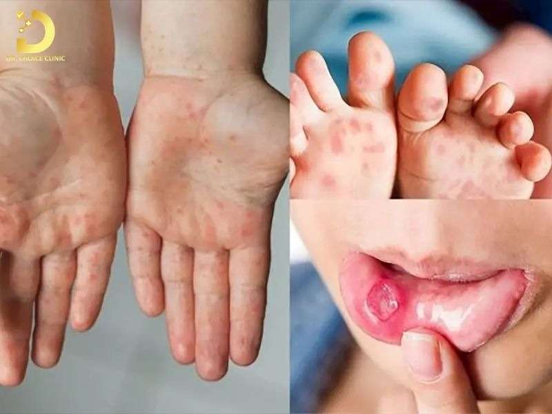 Top Bệnh Về Da Mùa Hè Thường Gặp & Cách Phòng Ngừa Hiệu Quả 26 Bệnh tay chân miệng
