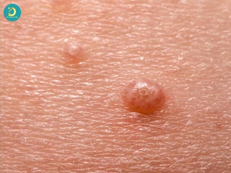 Các Bệnh Ngoài Da Do Virus Thường Gặp & Cách Điều Trị Hiệu Quả 19 U mềm lây là bệnh ngoài da do Molluscum contagiosum virus gây ra