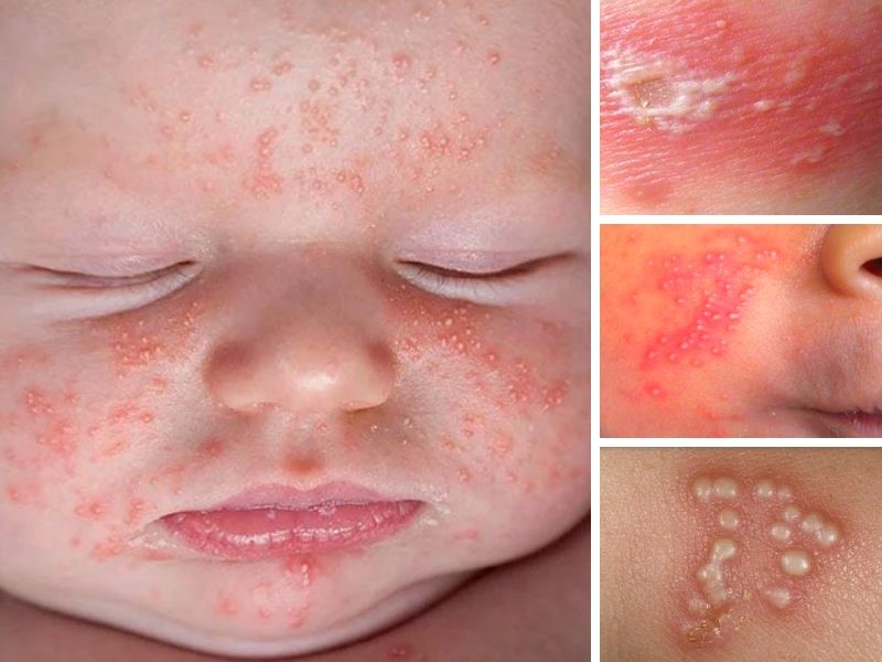 Viêm Da Mủ Ở Trẻ Em: Nguyên Nhân, Triệu Chứng & Cách Điều Trị, Phòng Ngừa 8 Hình ảnh trẻ bị bệnh viêm da mủ