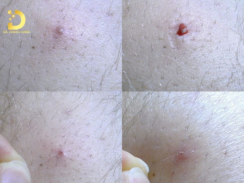 Bệnh Viêm Nang Lông Mùa Hè: Nguyên Nhân, Cách Điều Trị Và Phòng Ngừa Hiệu Quả 10 Hình ảnh viêm nang lông mùa hè