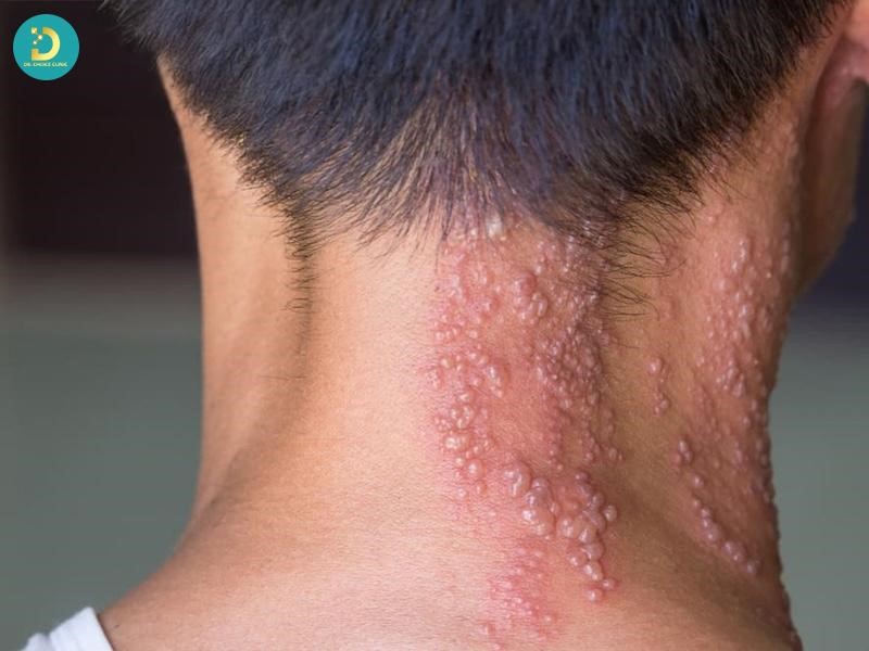 Các Bệnh Ngoài Da Do Virus Thường Gặp & Cách Điều Trị Hiệu Quả 16 Zona thần kinh là bệnh do virus Varicella-zoster gây ra