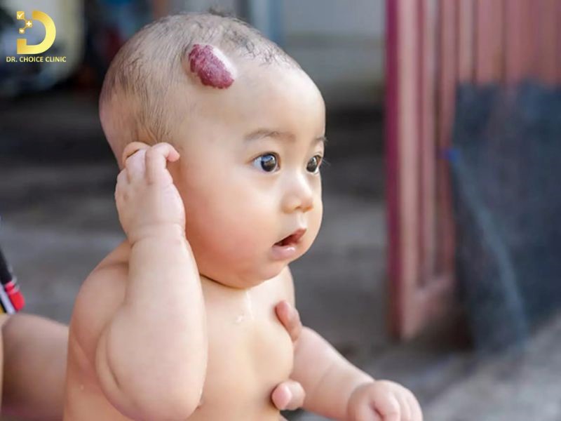 U Máu Ở Trẻ Em: Nguyên Nhân, Biểu Hiện, Khi Nào Cần Can Thiệp Điều Trị? 13 U máu gây ra nhiều biến chứng cho trẻ