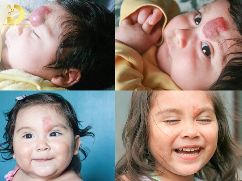 U Máu Ở Trẻ Em: Nguyên Nhân, Biểu Hiện, Khi Nào Cần Can Thiệp Điều Trị? 12 Dấu hiệu nhận biết trẻ bị u máu