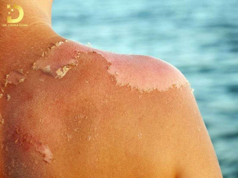 Top Bệnh Về Da Mùa Hè Thường Gặp & Cách Phòng Ngừa Hiệu Quả 33 Bỏng nắng