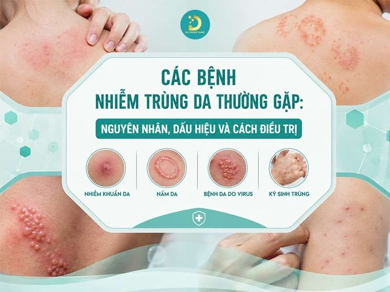 Các Bệnh Nhiễm Trùng Da Thường Gặp: Nguyên Nhân, Dấu Hiệu Và Cách Điều Trị 12 Các bệnh nhiễm trùng da thường gặp