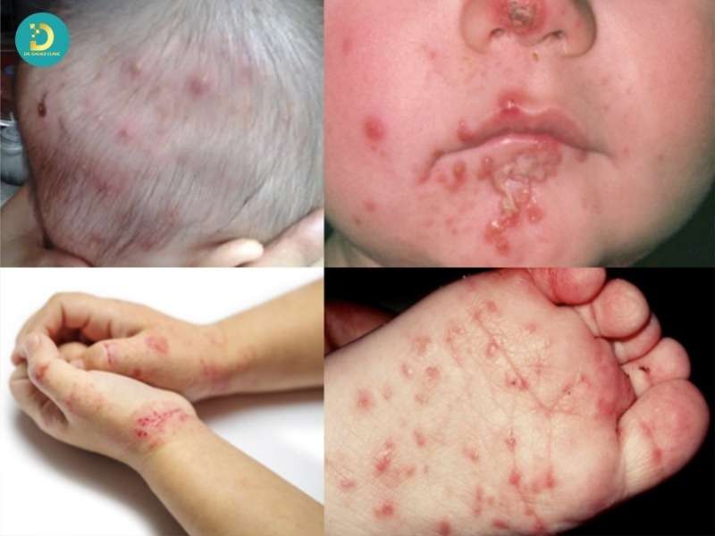 Bệnh Chốc Lở: Nguyên Nhân, Dấu Hiệu, Cách Điều Trị Và Phòng Ngừa Bệnh 16 Các vị trí thường bị chốc lở