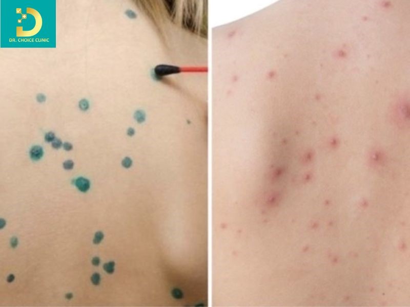 Thủy Đậu: Nguyên Nhân, Triệu Chứng, Biến Chứng & Cách Điều Trị, Phòng Ngừa Tại Nhà 12 Phần lớn bệnh thủy đậu có thể tự điều trị tại nhà