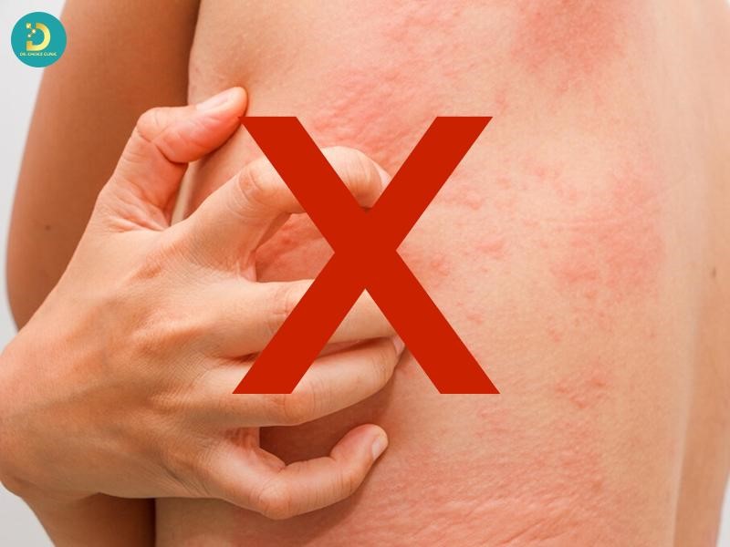 Các Bệnh Ngoài Da Do Virus Thường Gặp & Cách Điều Trị Hiệu Quả 24 Người bệnh tránh ma sát mạnh lên vùng da tổn thương