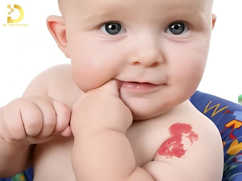 U Máu Ở Trẻ Em: Nguyên Nhân, Biểu Hiện, Khi Nào Cần Can Thiệp Điều Trị? 14 Chăm sóc tại nhà đóng vai trò quan trọng trong quản lý u máu trẻ em