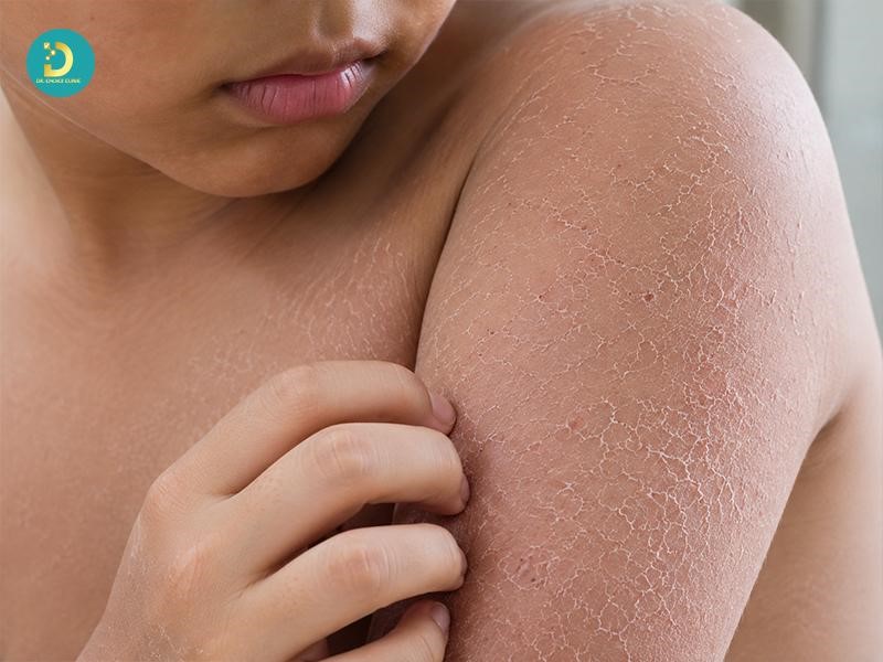 Bệnh Vảy Cá Ở Trẻ Em: Nguyên Nhân, Triệu Chứng & Cách Điều Trị Hiệu Quả 13 Dấu hiệu nhận biết bệnh vảy cá ở trẻ em