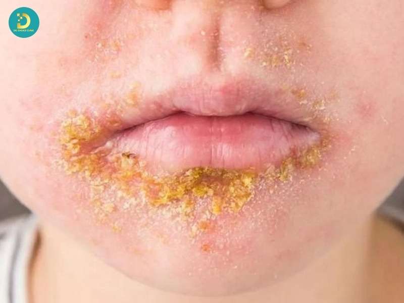 Bệnh Chốc Lở: Nguyên Nhân, Dấu Hiệu, Cách Điều Trị Và Phòng Ngừa Bệnh 15 Dấu hiệu điển hình khi bệnh tiến triển