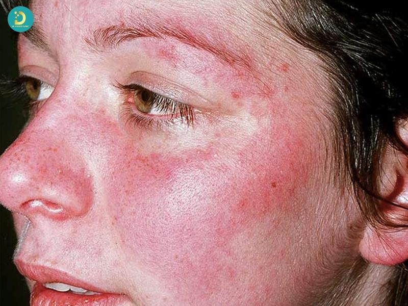 Lupus Ban Đỏ Hệ Thống: Nguyên Nhân, Biểu Hiện, Chẩn Đoán Và Cách Điều Trị 10 Dấu hiệu nhận biết Lupus ban đỏ hệ thống