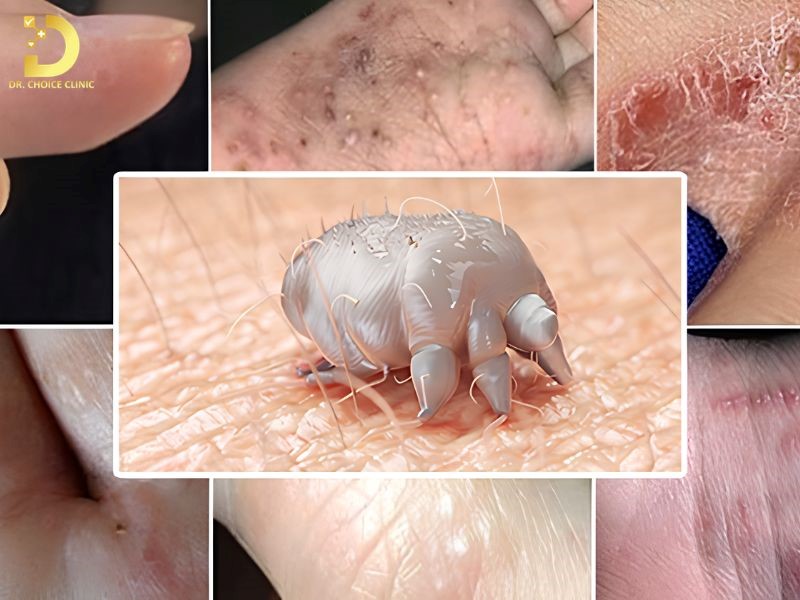 Cái Ghẻ Là Gì? Nguyên Nhân, Triệu Chứng, Cách Điều Trị & Phòng Ngừa 9 Triệu chứng bệnh ghẻ bao gồm ngứa dữ dội về đêm, sự xuất hiện của luống ghẻ và mụn nước.