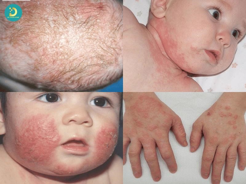 Viêm Da Cơ Địa Ở Trẻ Em: Dấu Hiệu Và Phác Đồ Điều Trị 10 Dấu hiệu viêm da cơ địa trẻ em