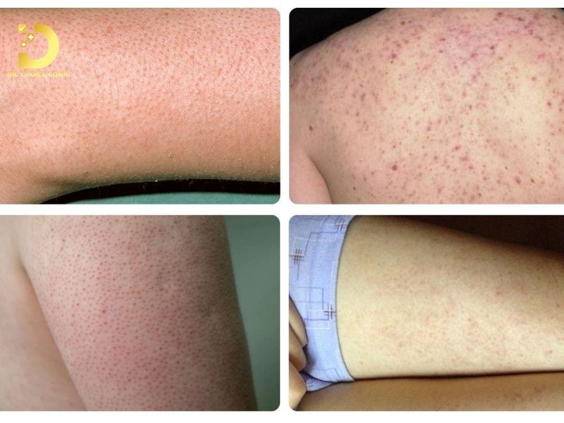 Bệnh Viêm Nang Lông Mùa Hè: Nguyên Nhân, Cách Điều Trị Và Phòng Ngừa Hiệu Quả 9 Dấu hiệu nhận biết viêm nang lông mùa hè