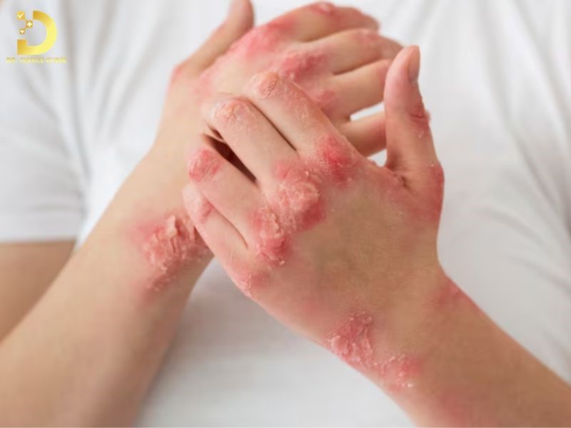 Cái Ghẻ Là Gì? Nguyên Nhân, Triệu Chứng, Cách Điều Trị & Phòng Ngừa 10 Điều trị bệnh ghẻ