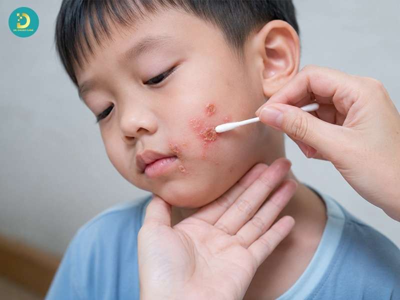 Bệnh Chốc Lở: Nguyên Nhân, Dấu Hiệu, Cách Điều Trị Và Phòng Ngừa Bệnh 17 Điều trị chốc lở nhẹ tại nhà như thế nào?