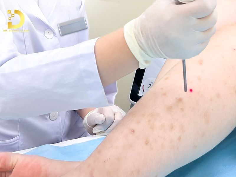 Bệnh Viêm Nang Lông Mùa Hè: Nguyên Nhân, Cách Điều Trị Và Phòng Ngừa Hiệu Quả 12 Can thiệp chuyên sâu cho trường hợp nặng hoặc tái phát