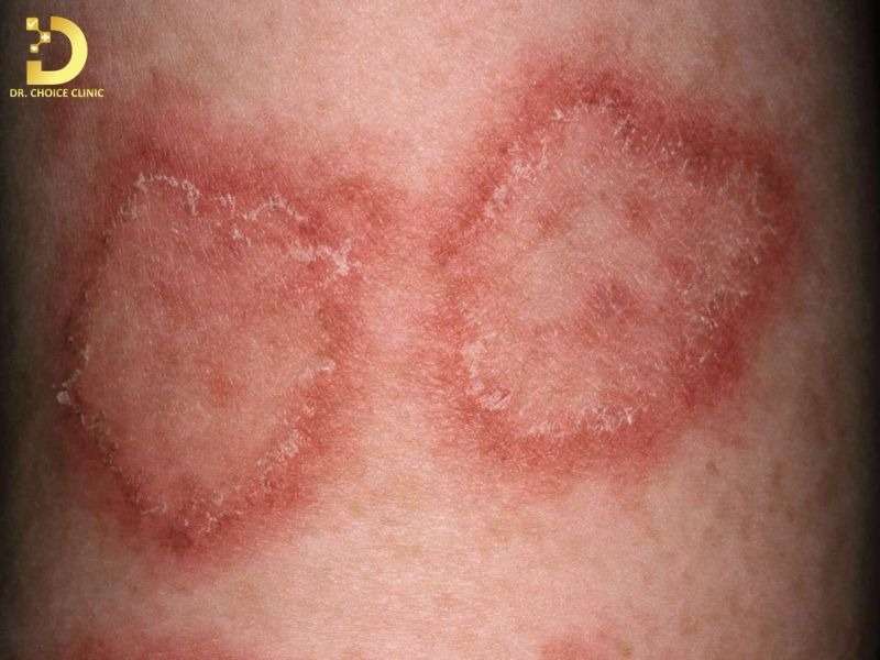 Top Bệnh Về Da Mùa Hè Thường Gặp & Cách Phòng Ngừa Hiệu Quả 31 hac lao