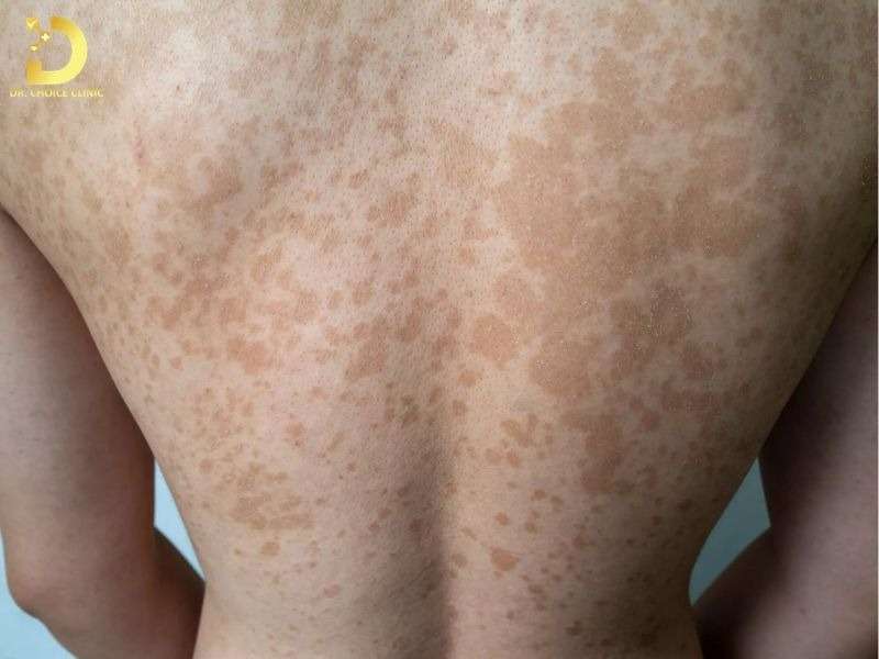 Top Bệnh Về Da Mùa Hè Thường Gặp & Cách Phòng Ngừa Hiệu Quả 30 Lang ben