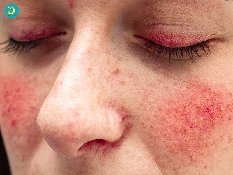 Lupus Ban Đỏ Hệ Thống: Nguyên Nhân, Biểu Hiện, Chẩn Đoán Và Cách Điều Trị 9 Hình ảnh bị Lupus ban đỏ hệ thống