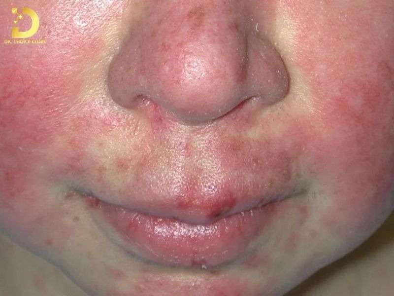 Top Bệnh Về Da Mùa Hè Thường Gặp & Cách Phòng Ngừa Hiệu Quả 37 Lupus ban đỏ
