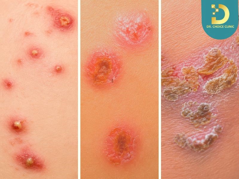 Viêm Da Mủ Ở Trẻ Em: Nguyên Nhân, Triệu Chứng & Cách Điều Trị, Phòng Ngừa 9 Các loại viêm da mủ trẻ em phổ biến
